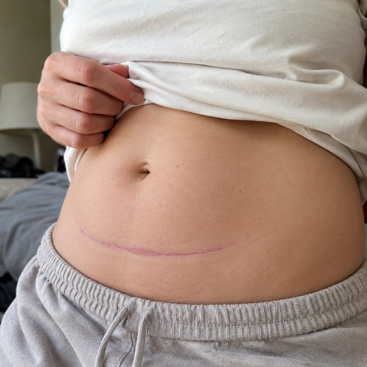 C-section scar review photo before