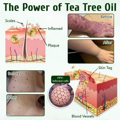✅ Timilk® Tea Tree Skin Healing Cream