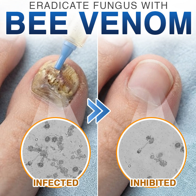 🇨🇦 CareBreeze® Fungi Free Bee Venom Nail Treatment 🥼