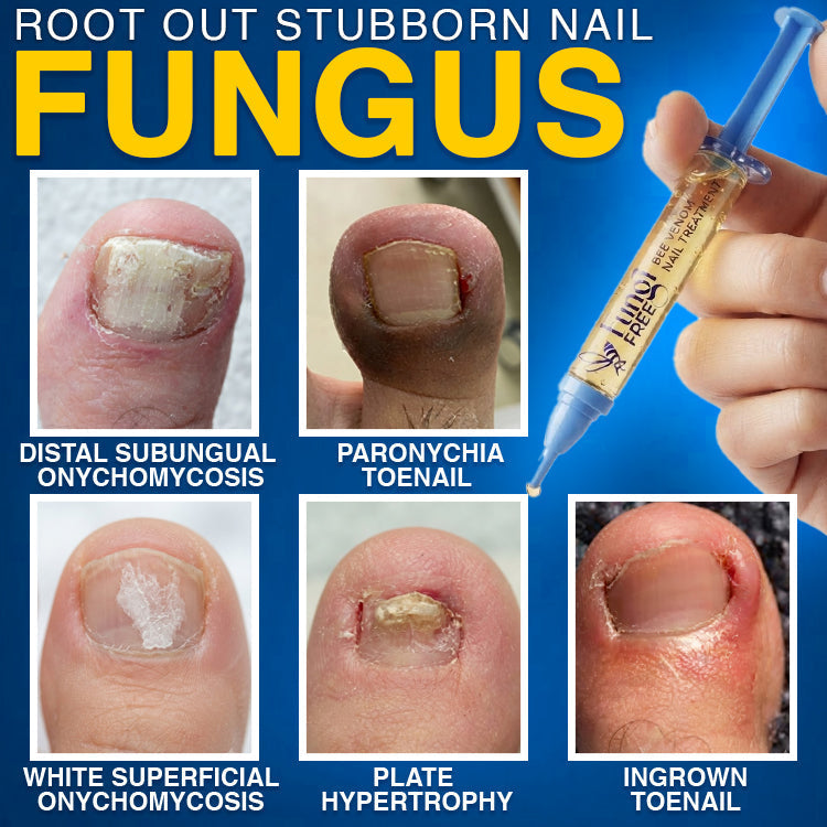 🇨🇦 CareBreeze® Fungi Free Bee Venom Nail Treatment 🥼