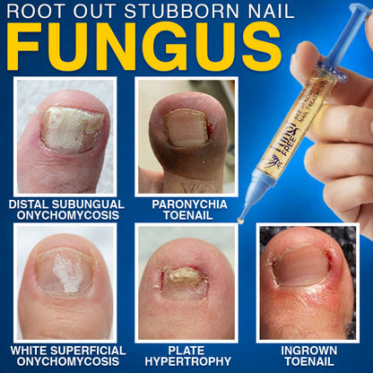🇨🇦 CareBreeze® Fungi Free Bee Venom Nail Treatment 🥼