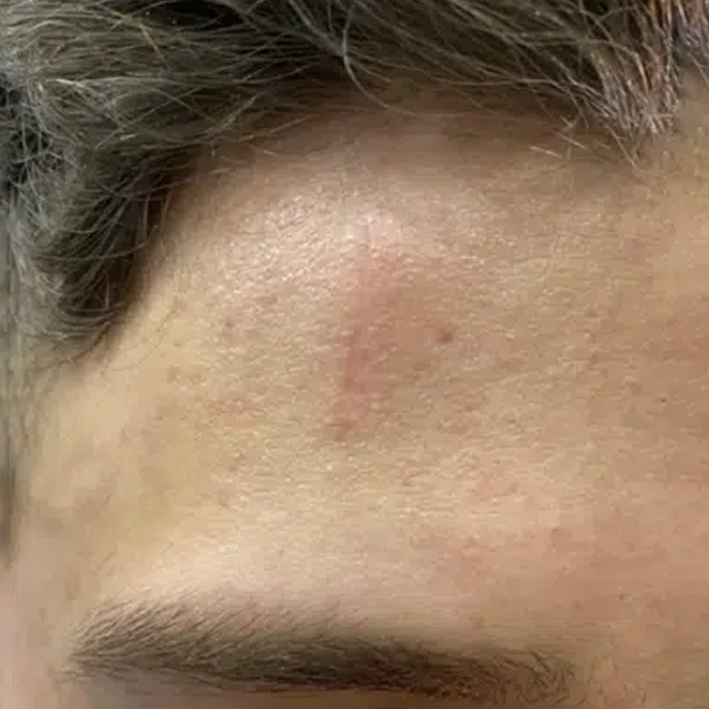 Scar After Treatment