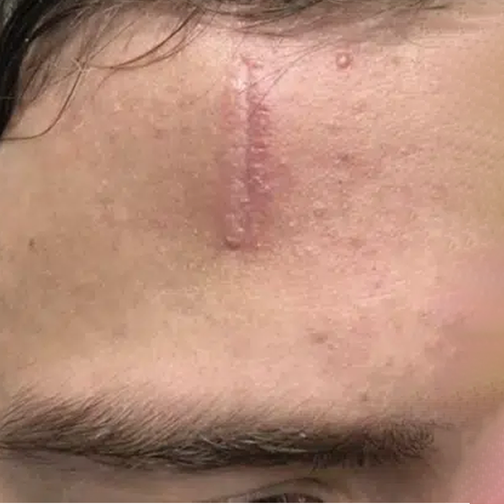 Scar Before Treatment