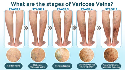 VenaRestore MicroNeedle Vein Repair Patch 🇺🇸