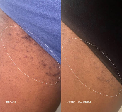 Lonqi® High Roller Ingrown Tonic