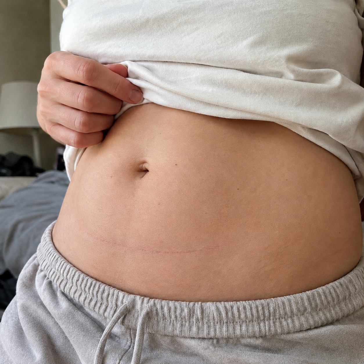 C-section scar review photo after
